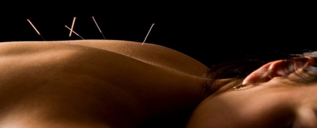 L’acupuncture permet-elle d’atténuer les symptômes du SII ?